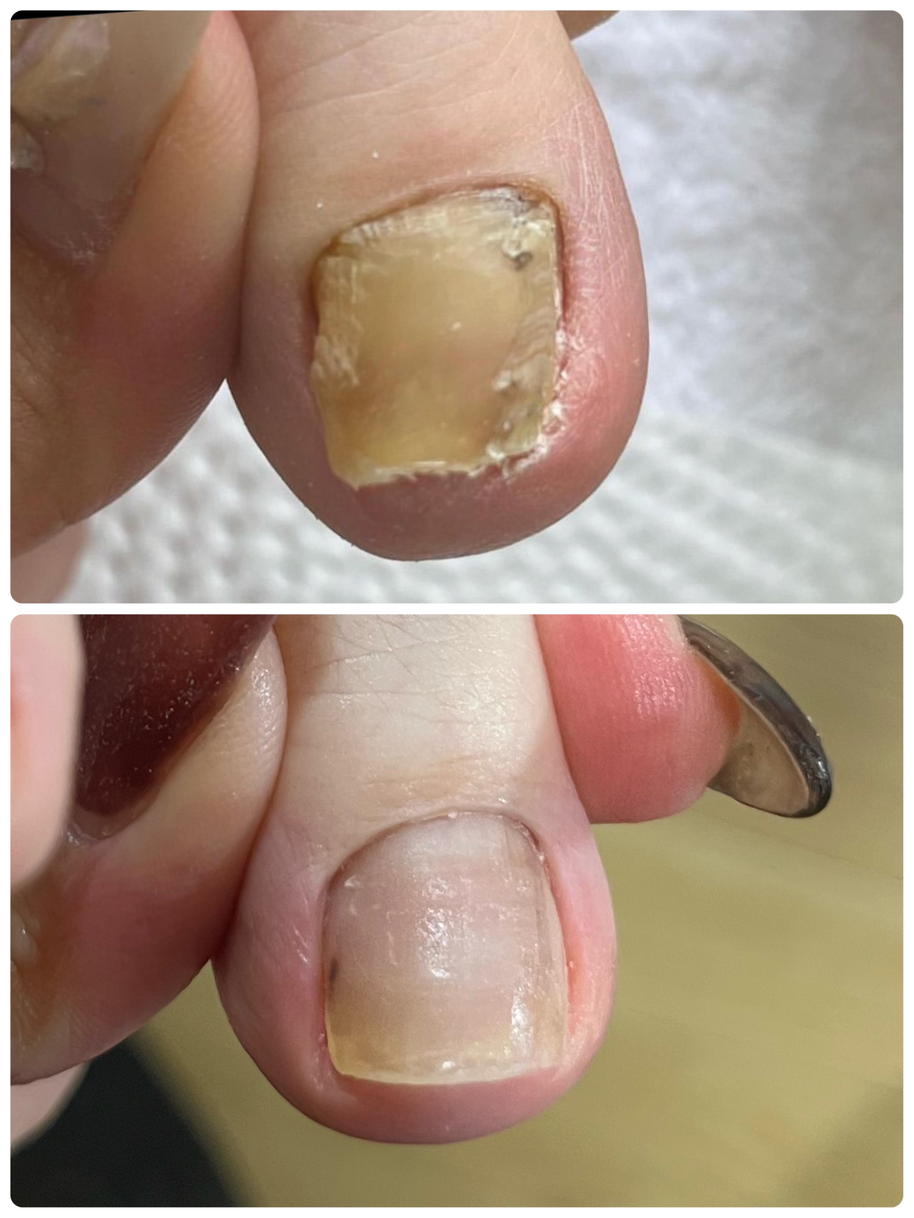 爪甲鉤彎症ケア