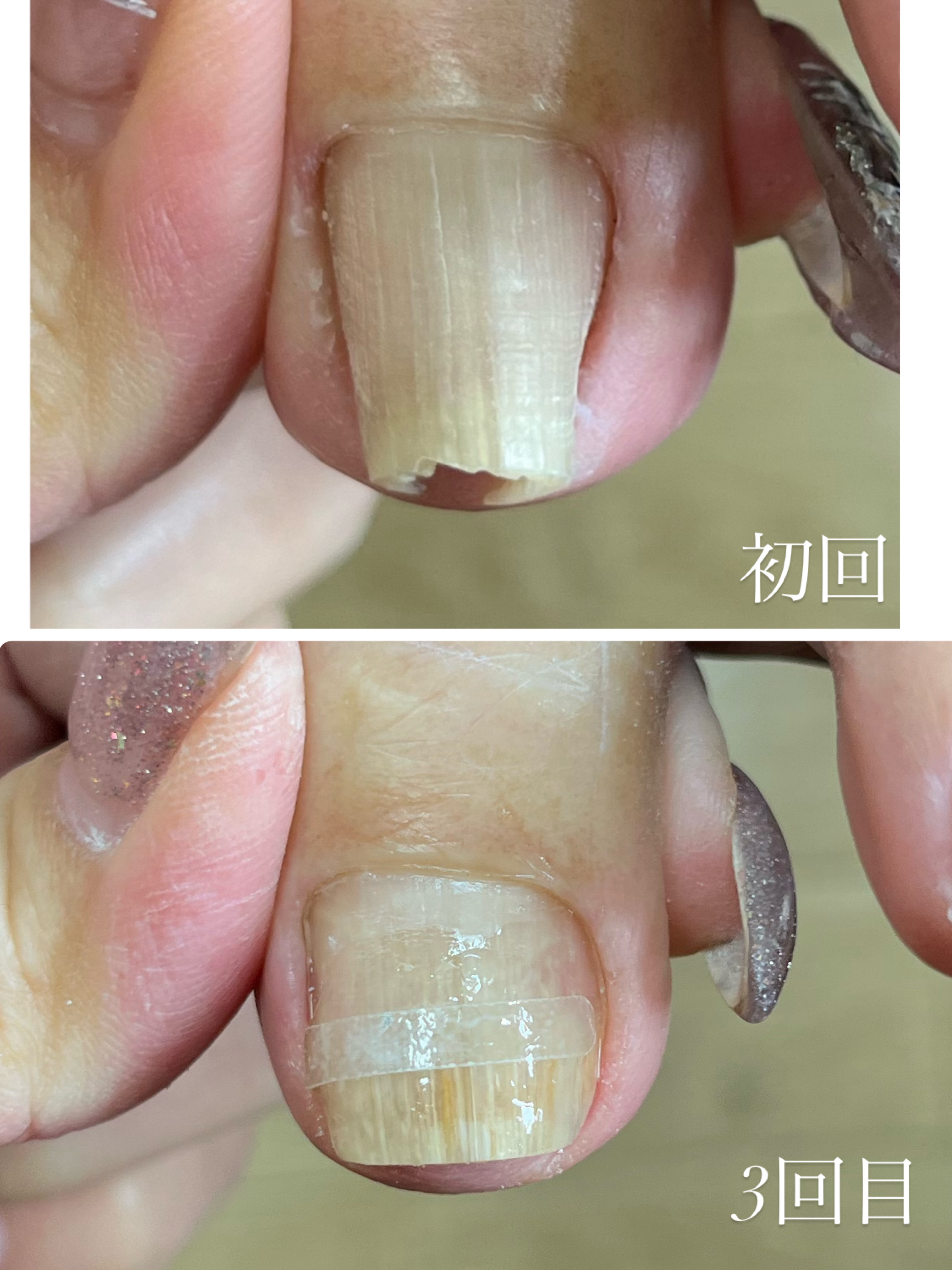 巻き爪ケア 初回→3回目の変化