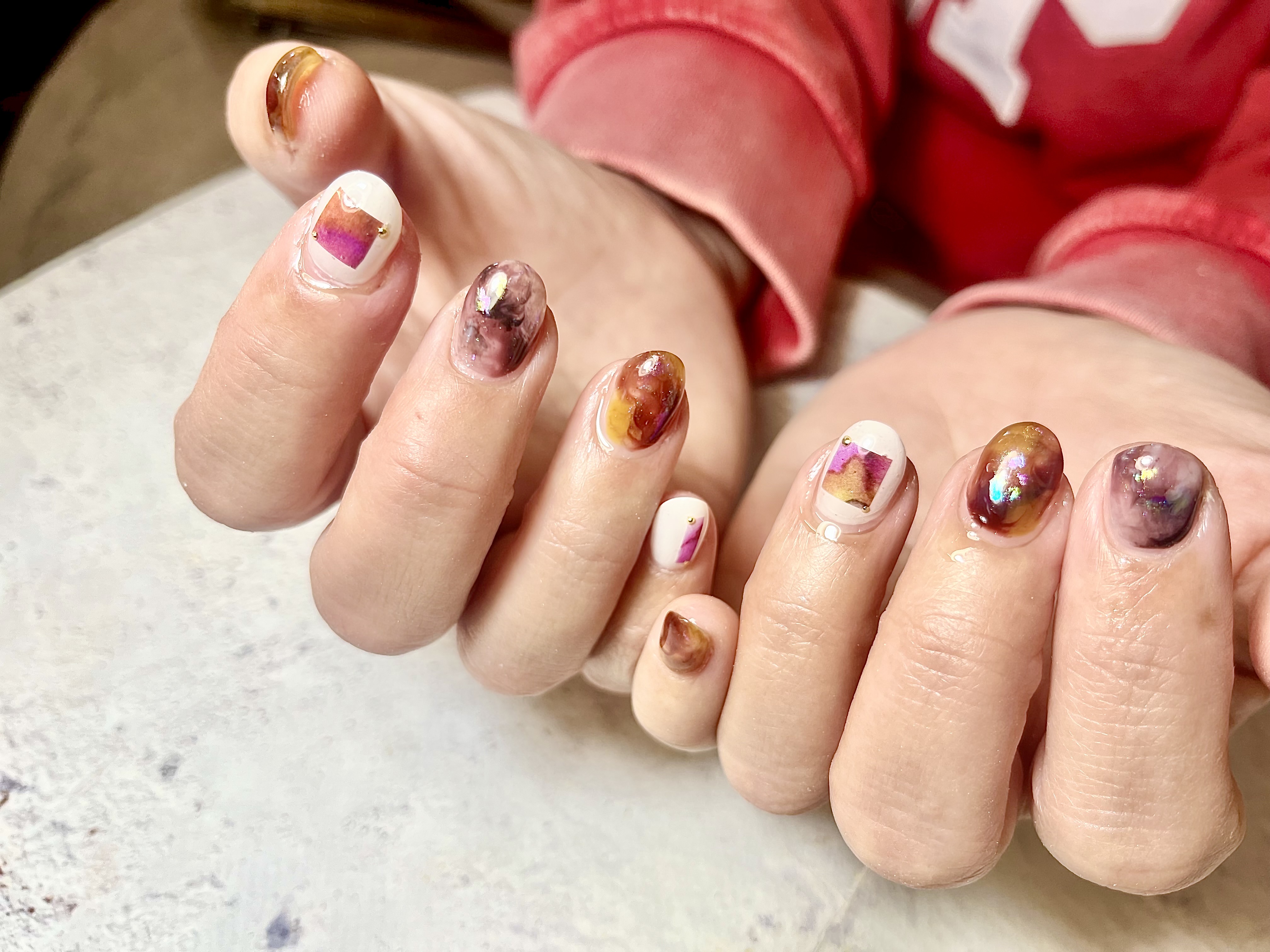 巻き爪ケア施術例