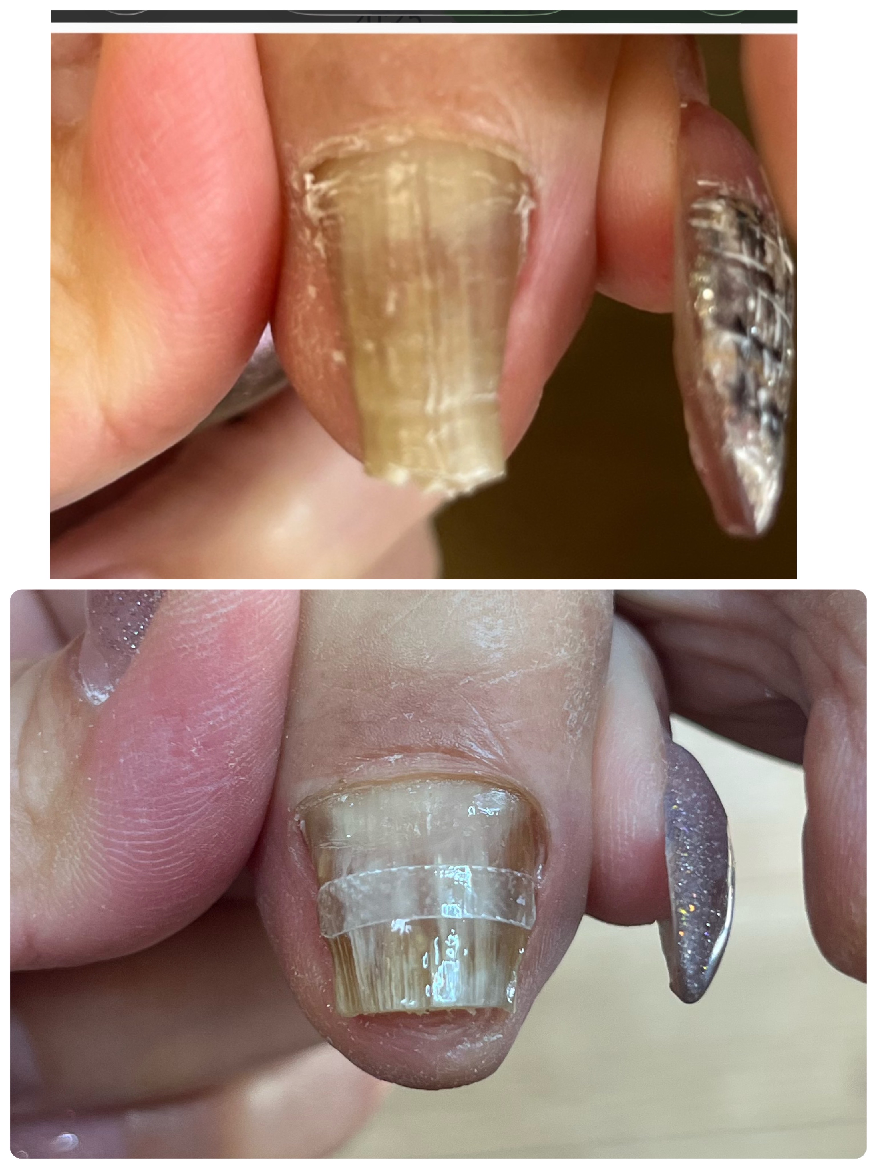 爪甲鉤彎症ケア